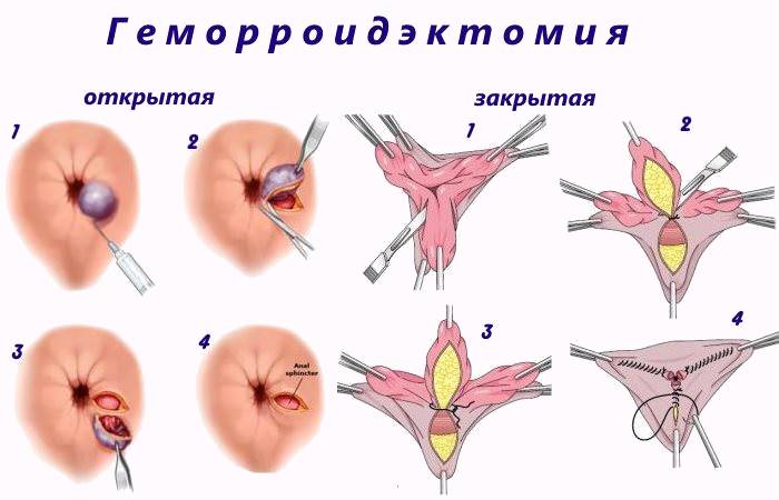 Геморроидэктомия на схеме