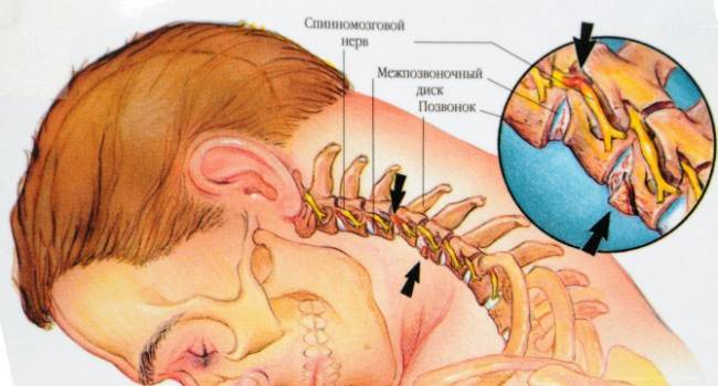 6 причин болей в шее