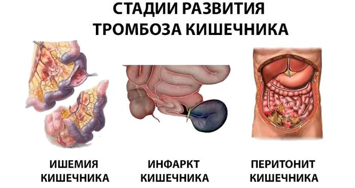 Стадии развития тромбоза кишечника
