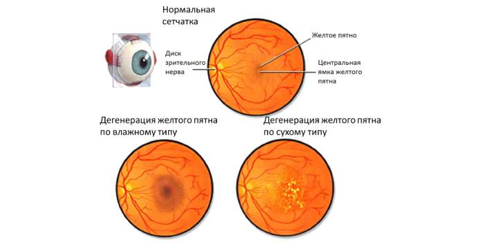 Дегенерация желтого тела глаза