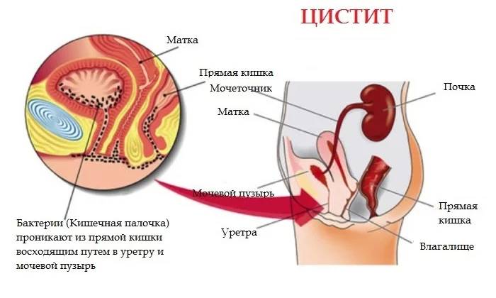 11 симптомов инфекции мочевыводящих путей