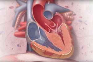 Что такое гипертрофическая кардиомиопатия
