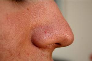 Лечение и профилактика угрей на носу