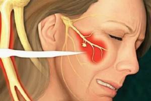 Что такое невралгия тройничного нерва