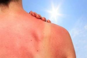 Как распознать и предотвратить аллергию на солнце