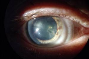 5 важных фактов о катаракте