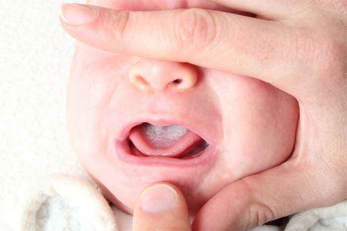 Молочница во рту у новорожденного
