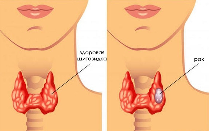 Киста щитовидной желез и беременность Киста щитовидной желез и беременность