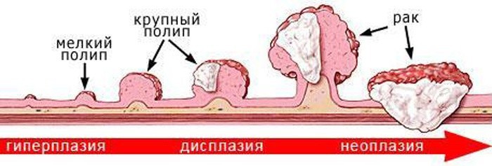 Разновидности полипоза