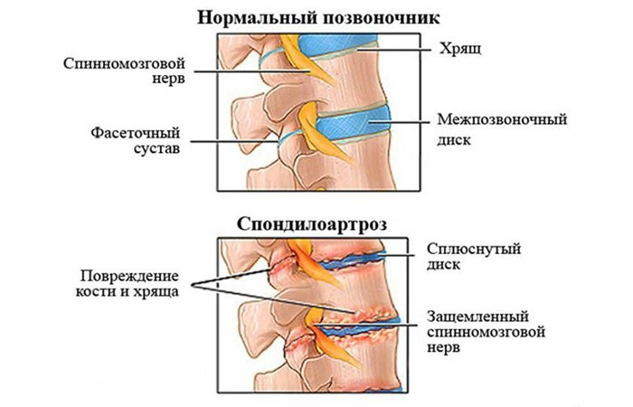 Схематическое изображение здорового позвоночника и пораженного спондилоартрозом