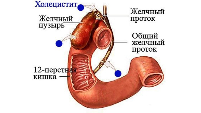 Хронический холецистит как лечить какая диета Хронический холецистит как лечить какая диета