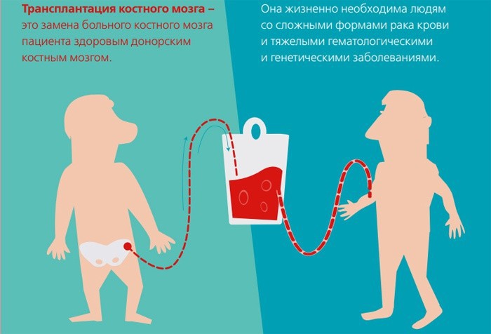 Пересадка костного мозга как происходит