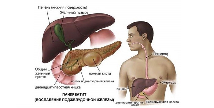 Лечение панкреатита в домашних условиях 25 Лечение панкреатита в домашних условиях 17