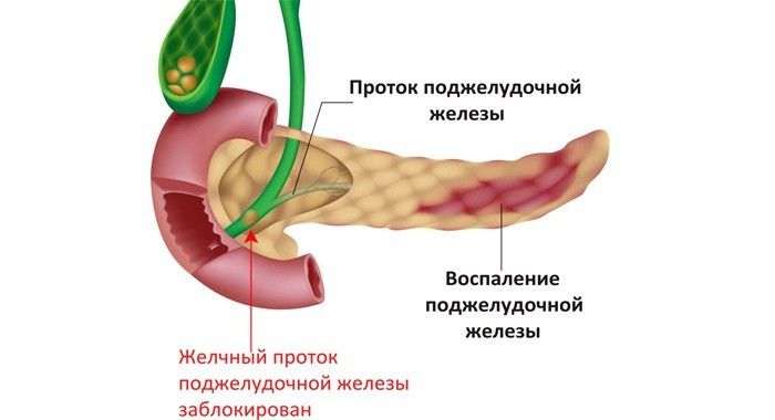 Как лечить поджелудочную железу в домашних условиях быстро отзывы 134