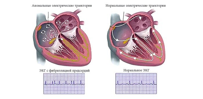 Как лечить мерцательную аритмию народными средствами