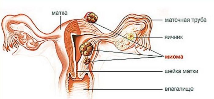 Сгустки крови во время месячных - причины возникновения методы лечения