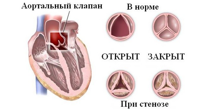 Сравнение здорового и больного артериального клапана