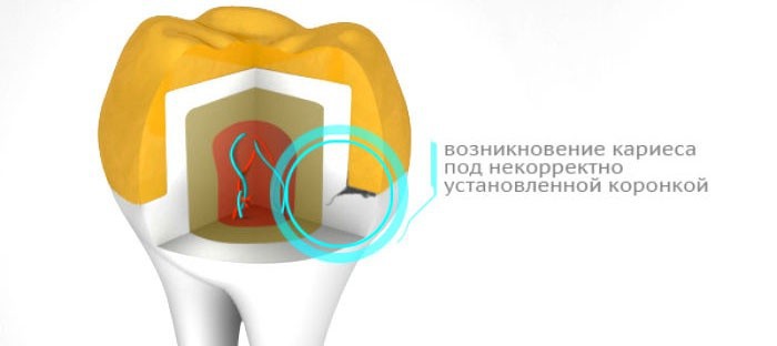Болят все зубы под коронками причина Шацкая - Библия стервы. Читать онлайн