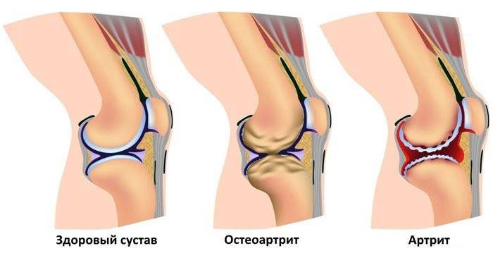 схема здорового колена и после артрита, остеоартрита