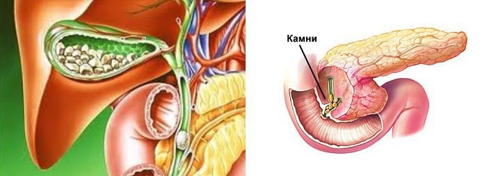 Камень в желчном пузыре 3 см что делать если не беспокоит