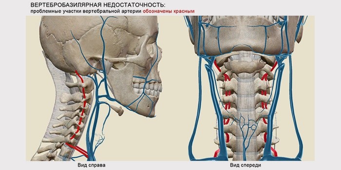 Вертебро-базилярная недостаточность