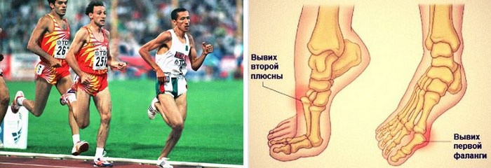 Почему болит большой палец на левой ноге