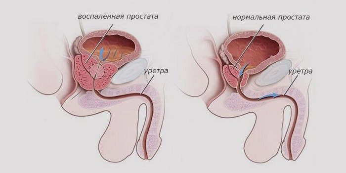 Рак предстательной железы Википедия Простатит