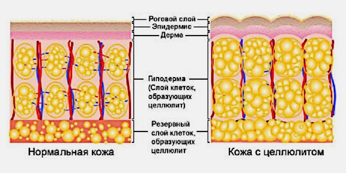 как убрать жир с ляшек отзывы как убрать жир с ляшек отзывы
