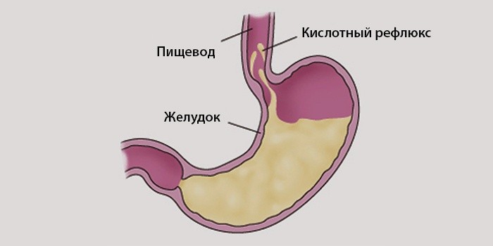 Почему бывает отрыжка после еды у взрослых Почему бывает отрыжка после еды у взрослых