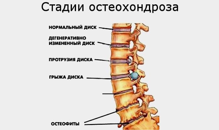 Стадии развития остеохондроза