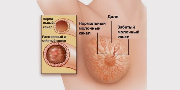 Прыщи на сосках у кормящей мамы Прыщи на сосках у кормящей мамы