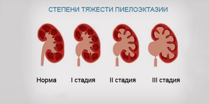 Как лечить пиелоэктазия почки у новорожденного Как лечить пиелоэктазия почки у новорожденного