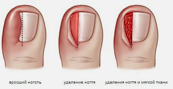 Пол ногтя растет а пол нет Пол ногтя растет а пол нет