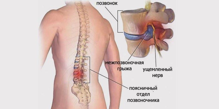 Пояснично крестцовый отдел как лечить симптомы Пояснично крестцовый отдел как лечить симптомы