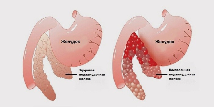В домашних условиях полечить поджелудочную железу В домашних условиях полечить поджелудочную железу