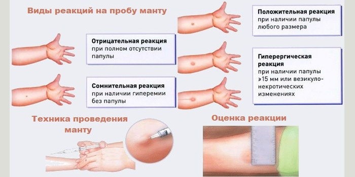 Может ли ребёнок заболеть от прививки манту Может ли ребёнок заболеть от прививки манту
