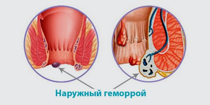 Геморрой у беременных лечение 18