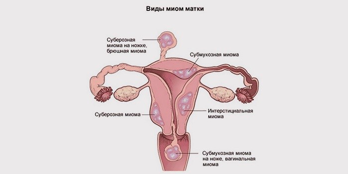 Миома матки: лечение народными средствами эффективно и без операции