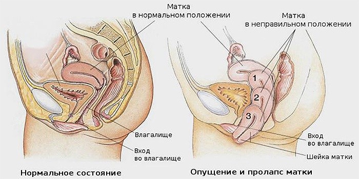 Выпадение матки Выпадение матки