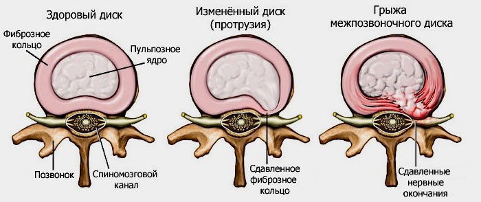 Межпозвоночная грыжа