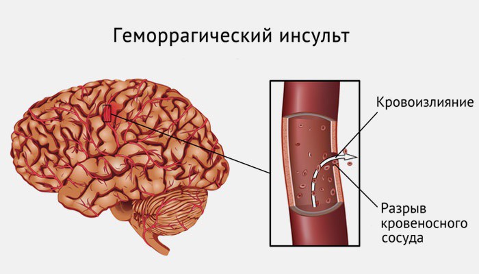 Схематическое изображение геморрагического инсульта головного мозга