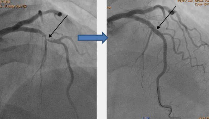 Операция стентирования сосудов сердца Операция стентирования сосудов сердца
