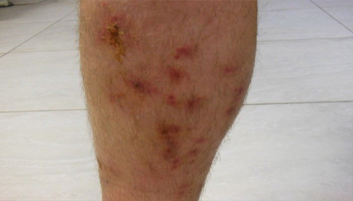 Рожистое воспаление кожи ноги и руки: симптомы и лечение в ...
