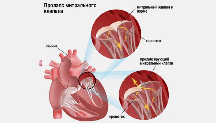 Пролапс митрального клапана и норма