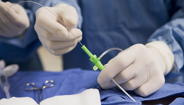 Операция стентирования сосудов сердца Операция стентирования сосудов сердца