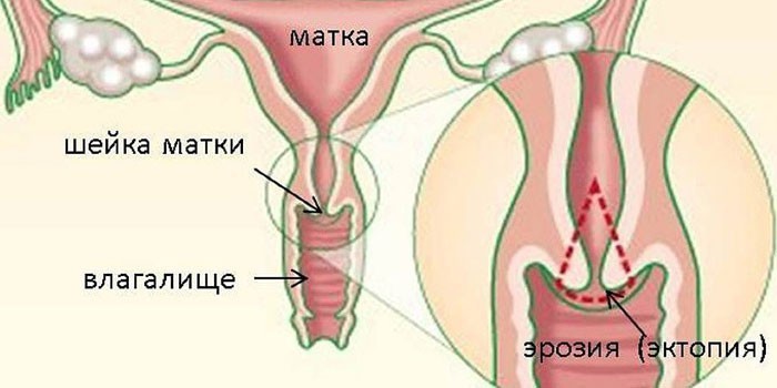 Эктопия шейки матки - признаки и симптомы, лечение цервикальной или хронической формы заболевания
