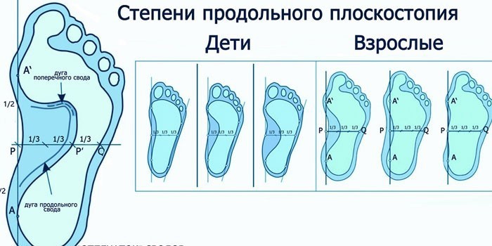 Как сделать большую степень плоскостопия Как сделать большую степень плоскостопия