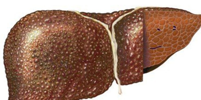 Печень пораженная циррозом 