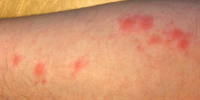 Чем обрабатывать укусы клопов на коже Чем обрабатывать укусы клопов на коже