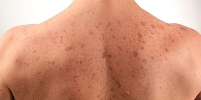 Пигментные пятна на коже спины